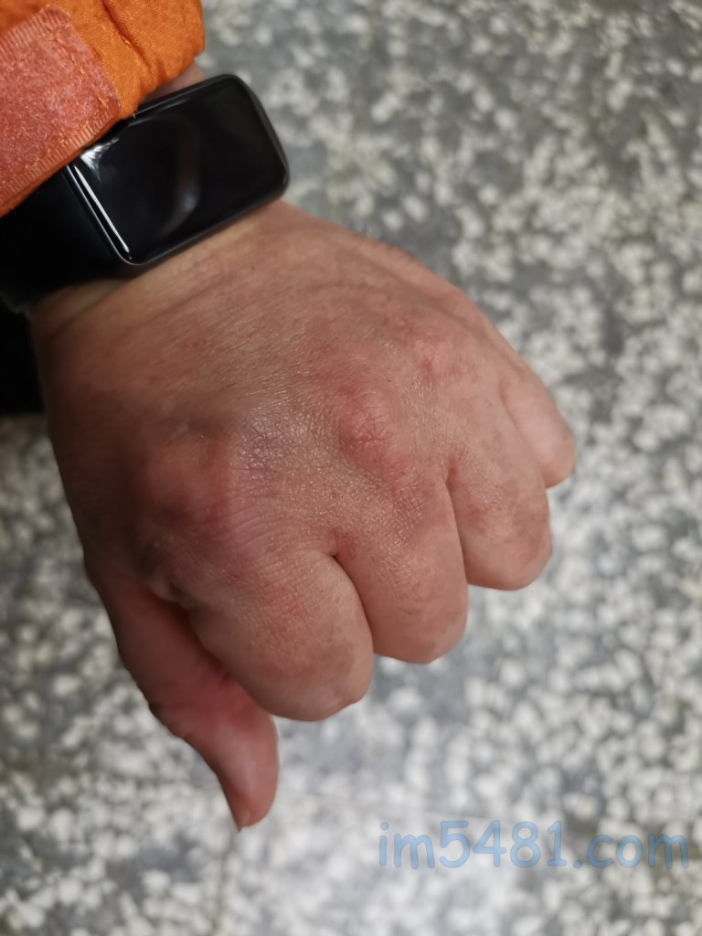 手部的皮膚呈現紅腫發紅的過敏反應現象