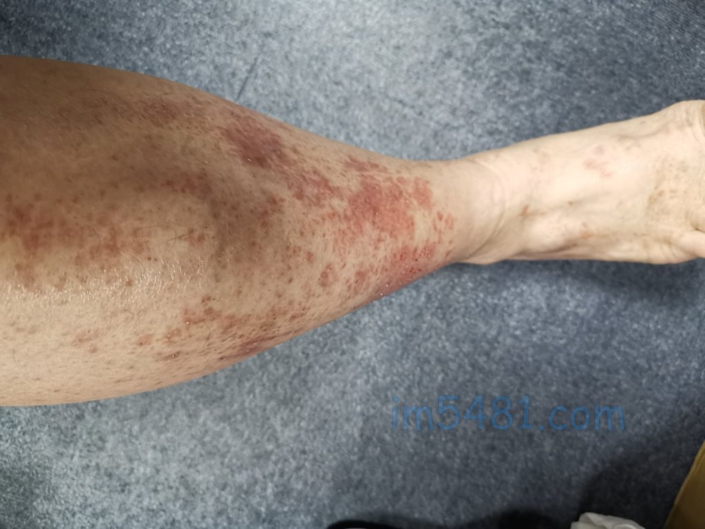小腿皮膚有明顯的血管發炎發腫發癢之過敏反應